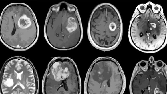 hallan-una-terapia-que-mejoraria-la-supervivencia-de-pacientes-con-tumor-cerebral