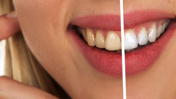 ¿se-considera-una-patologia-el-cambio-de-color-de-los-dientes?