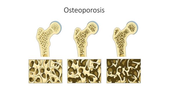 la-osteoporosis-en-mujeres-predice-un-mayor-riesgo-de-tener-enfermedades-cardiacas-e-ictus