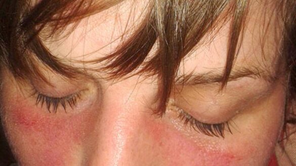 lupus-y-vacunacion-contra-la-covid-19:-si-es-recomendable,-pero-no-en-cualquier-momento-de-la-enfermedad