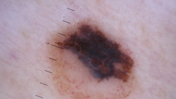 detectar-un-melanoma-a-tiempo-puede-alargar-la-superviviencia:-este-es-el-procedimiento-adecuado-para-identificarlos