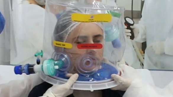 un-casco-de-respiracion-artificial-inventado-en-brasil-reduce-la-intubacion-en-un-60%