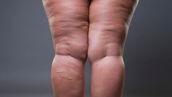 el-lipedema,-una-enfermedad-casi-exclusiva-de-las-mujeres-que-aun-esta-infravalorada-y-mal-diagnosticada