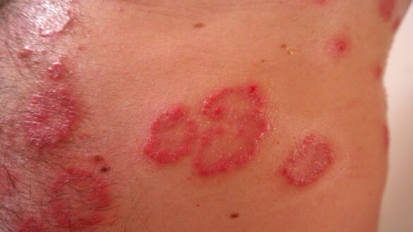 esta-enfermedad-cutanea,-puede-afectar-a-las-articulaciones-y-al-higado:-sintomas,-causas-y-tratamiento-de-la-psoriasis