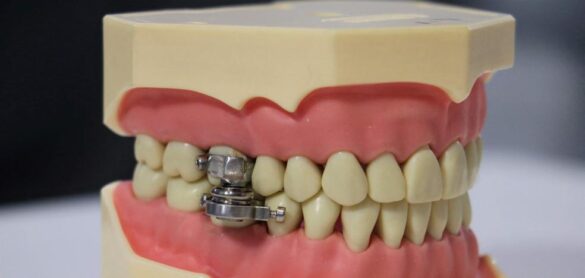 un-candado-en-los-dientes-para-adelgazar