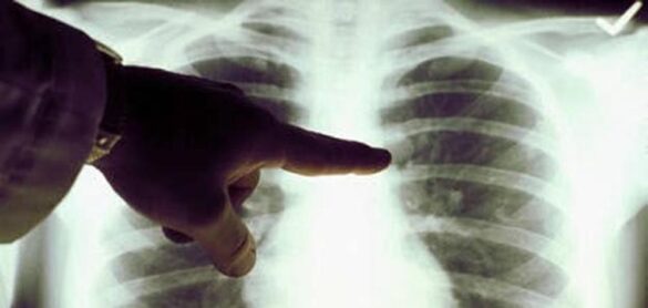 el-cancer-de-pulmon:-frecuente-y-mortal