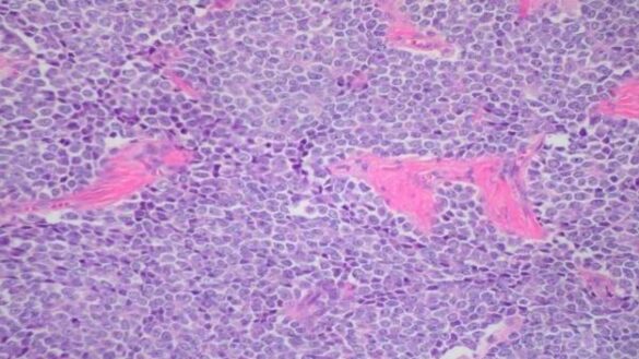 ¿que-es-el-sarcoma?-estos-son-los-sintomas,-las-causas-y-el-tratamiento-de-esta-forma-rara-de-cancer