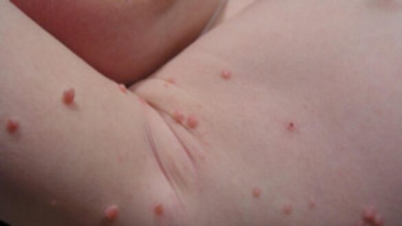 raspado,-crioterapia-y-otros-tratamientos-para-el-molusco-contagioso:-que-es-y-cuales-son-las-causas