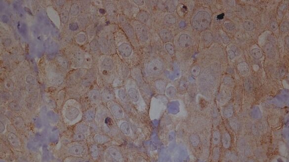 un-modelo-experimental-de-cancer-de-ovario-muestra-el-efecto-de-la-disposicion-de-las-celulas-sanas-en-la-metastasis