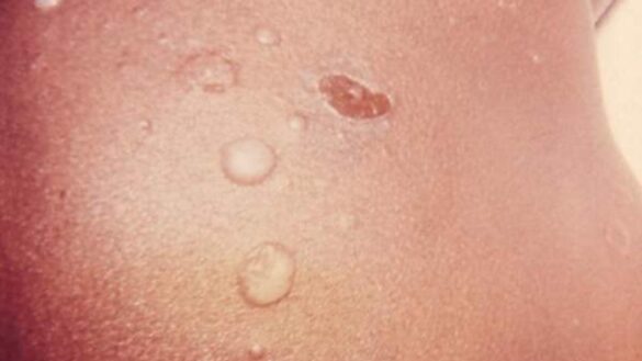 dermatitis-atopica,-clima-humedo-y-otros-factores-de-riesgo-para-sufrir-impetigo:-que-es,-causas-y-tratamiento