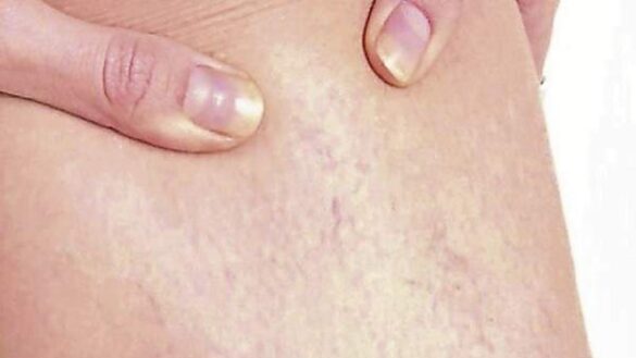 exposicion-al-sol,-rosacea-y-otras-causas-de-las-telangiectasias:-que-es-y-como-tratar-este-trastorno