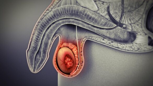 ¿tengo-cancer-de-testiculo?-estos-son-los-sintomas-a-los-que-debes-estar-alerta