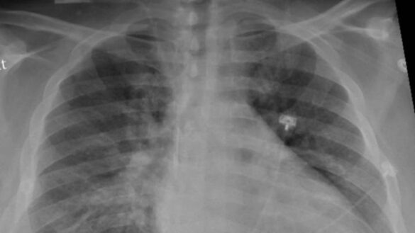disenan-una-herramienta-de-deteccion-de-covid-19-basada-en-imagenes-pulmonares-con-la-ayuda-de-ia