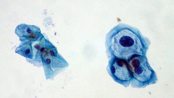 el-virus-del-papiloma-humano,-la-its-que-se-puede-contagiar-usando-condon
