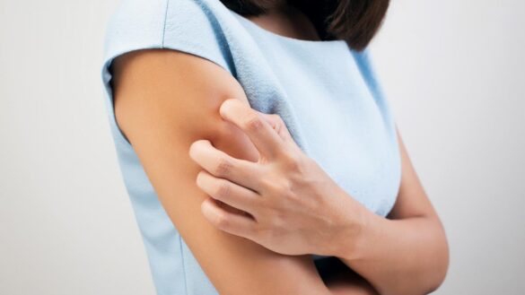 queratosis-pilar:-como-quitar-los-granitos-de-los-brazos-que-parecen-acne-pero-no-lo-es