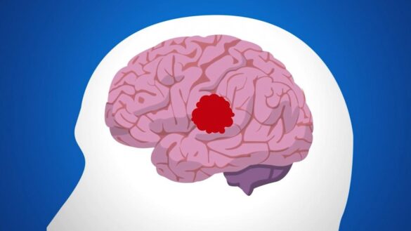 sintomas-del-ictus:-como-actuar-y-prevenir
