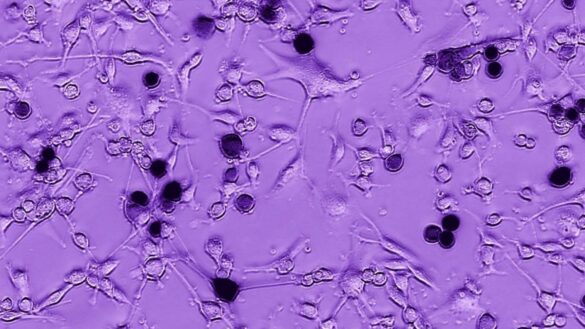 descubren-un-gen-que-desencadena-el-cancer-cerebral-de-peor-pronostico