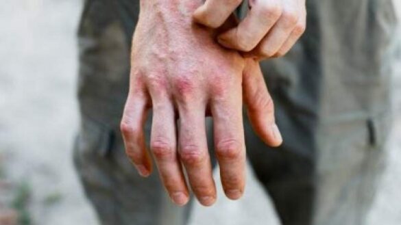 como-afrontar-una-dermatitis-atopica-en-otono-invierno