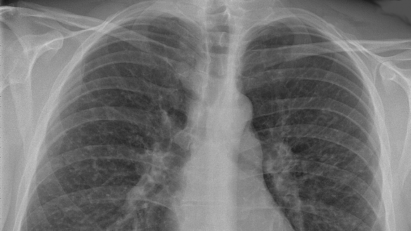 ¿que-es-la-sarcoidosis?-estos-son-sus-sintomas,-sus-causas-y-su-tratamiento