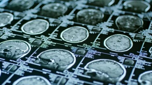 ¿que-es-un-ictus?-estos-son-sus-sintomas,-sus-causas-y-su-tratamiento