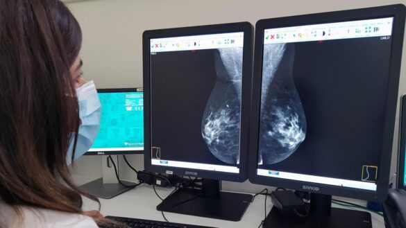 el-ganglio-linfatico-centinela:-clave-para-saber-hasta-que-punto-se-ha-propagado-el-cancer-de-mama