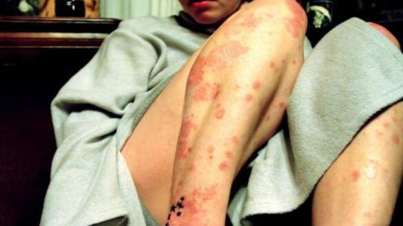 sarpullidos,-ampollas-y-otros-sintomas-de-la-dermatitis-atopica:-que-es-y-como-tratarla