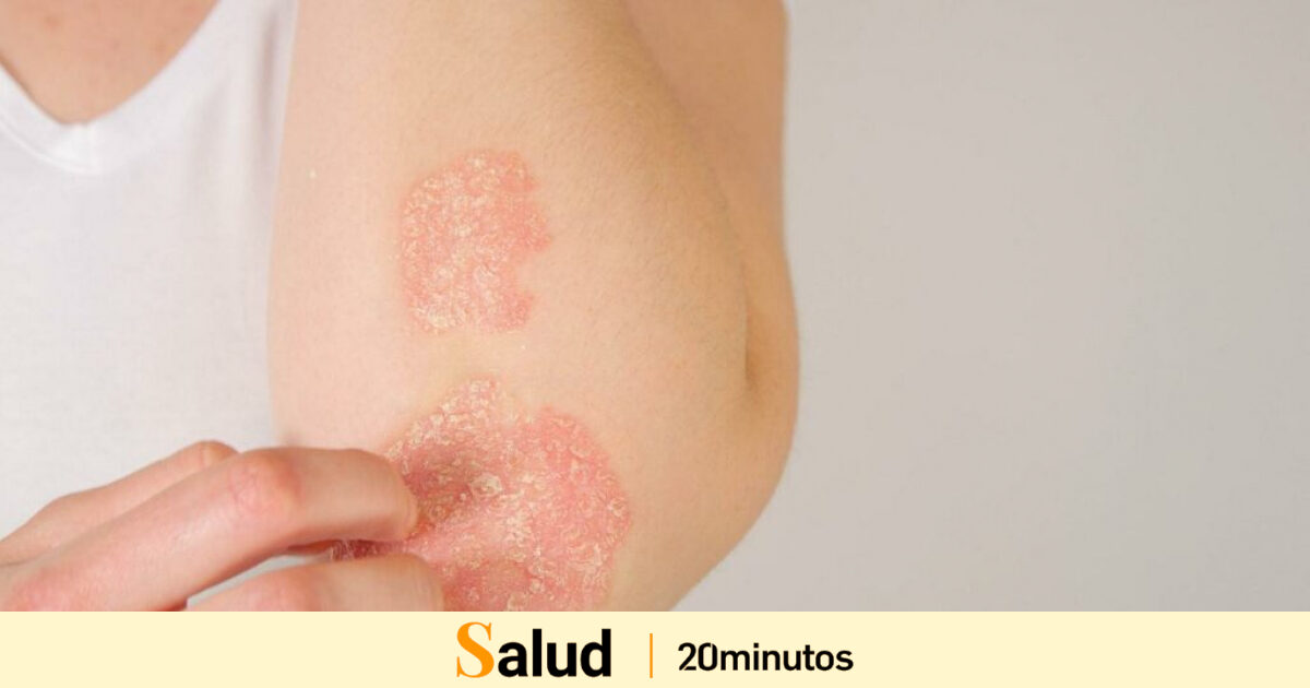 El cuidado de la piel con psoriasis, qué hacer y qué no para minimizar los brotes