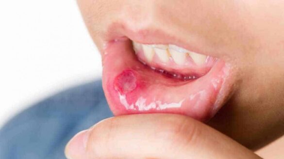 ¿que-es-el-herpes-simple?-estos-son-sus-sintomas,-sus-causas-y-su-tratamiento