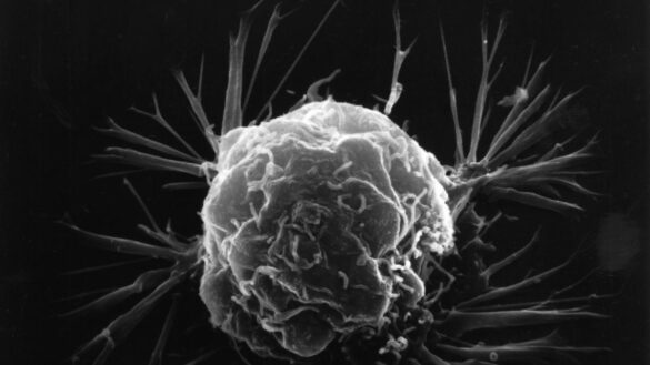descubren-como-las-celulas-del-cancer-de-mama-se-protegen-para-resistir-los-ataques-del-sistema-inmunitario