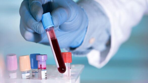 identifican-13-genes-que-aumentan-el-riesgo-de-alzheimer