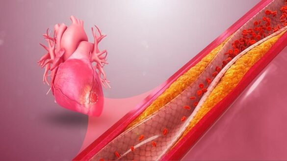 ¿que-es-la-arteriosclerosis?-estos-son-sus-sintomas,-sus-causas-y-su-tratamiento