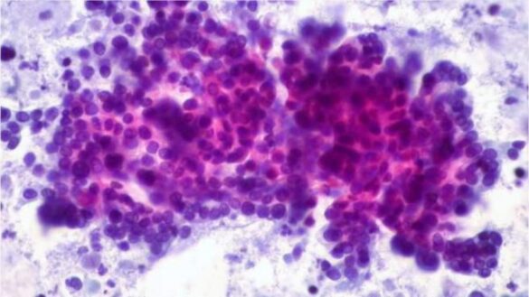 cuales-son-los-nuevos-sintomas-para-detectar-el-cancer-de-pancreas