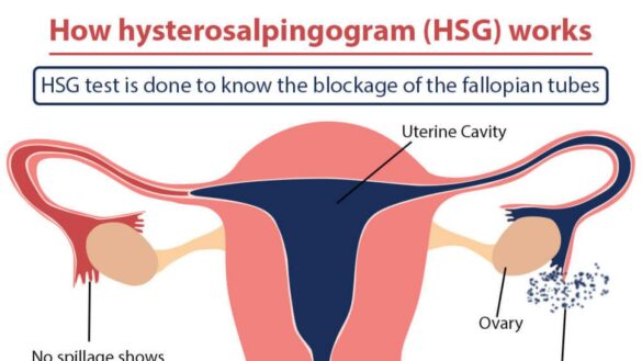 histerosalpingografia:-todo-lo-que-necesitas-saber-sobre-esta-prueba-radiologica-y-los-estudios-de-fertilidad