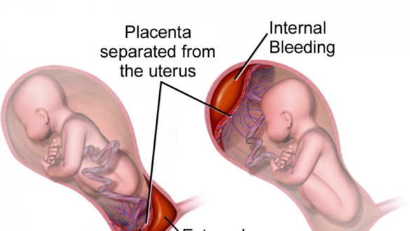 desprendimiento-de-placenta-en-el-embarazo:-que-es-y-como-se-trata