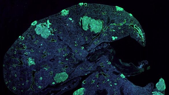 investigadores-espanoles-descubren-un-tratamiento-que-podria-hacer-frente-a-la-metastasis-del-melanoma