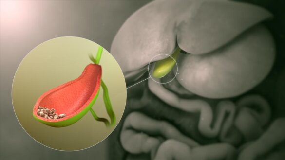 la-cirugia-laser-creada-por-un-cirujano-gallego-que-elimina-las-piedras-de-la-vesicula