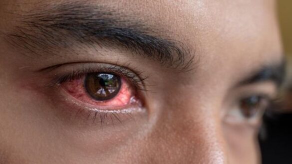 hinchazon-de-ojos,-picazon-y-otros-sintomas-del-tracoma:-que-es-y-como-tratarlo