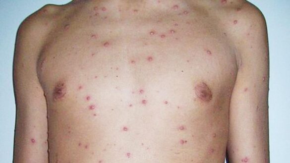 ¿que-es-el-sindrome-de-reye?-estos-son-sus-sintomas,-sus-causas-y-su-tratamiento