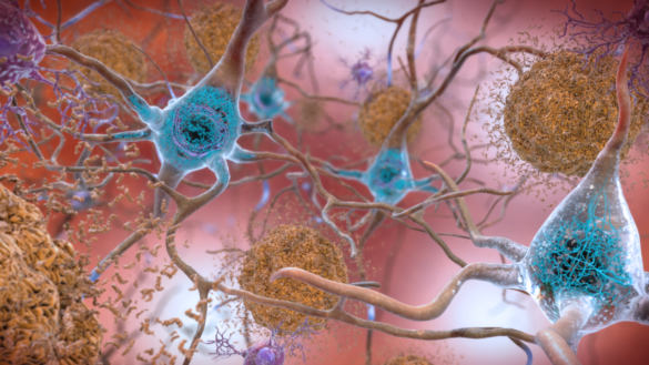 el-nuevo-tratamiento-experimental-contra-el-alzheimer-que-mejora-la-memoria-de-los-pacientes
