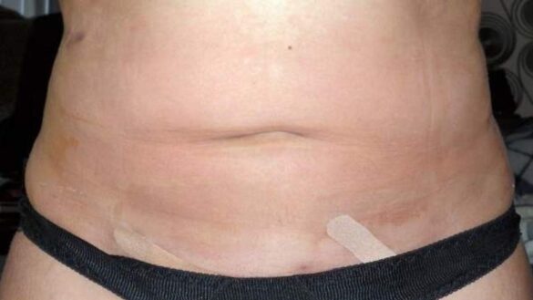 que-es-una-lipoescultura:-diferencias-con-la-liposuccion-y-riesgos-de-la-intervencion-quirurgica