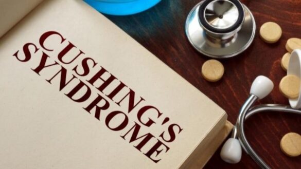estrias-y-otros-sintomas-del-sindrome-de-cushing