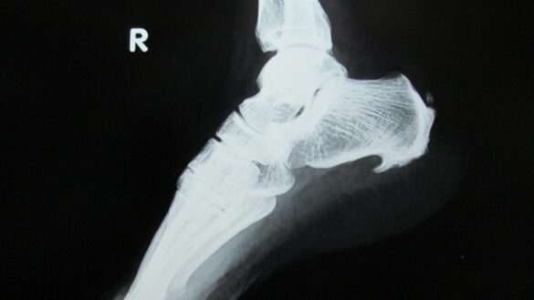 fascitis-plantar:-que-causa-el-espolon-calcaneo-y-cuales-son-los-tratamientos-mas-adecuados