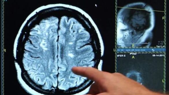 como-reconocer-los-sintomas-de-un-derrame-cerebral