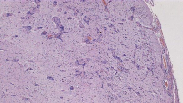 ¿que-es-la-neurofibromatosis?-estos-son-sus-sintomas,-sus-causas-y-su-tratamiento