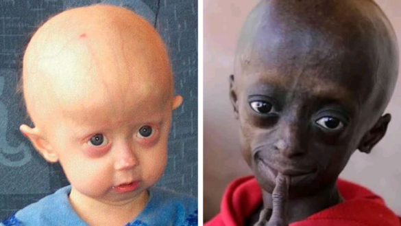 progeria:-la-enfermedad-que-acelera-el-envejecimiento-en-ninos