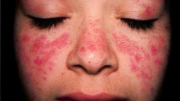 caracteristicas,-sintomas-y-complicaciones-del-lupus-pediatrico