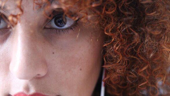 el-melasma,-el-trastorno-cutaneo-que-provoca-que-aparezcan-manchas-en-la-cara-al-exponerse-al-sol