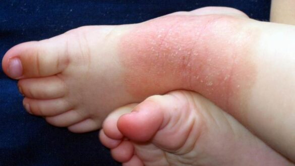 como-identificar-las-toxicodermias,-reacciones-cutaneas-a-medicamentos-y-sustancias-quimicas