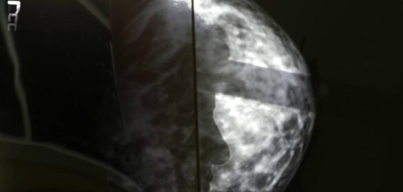 oncologia-de-precision-e-inteligencia-artificial