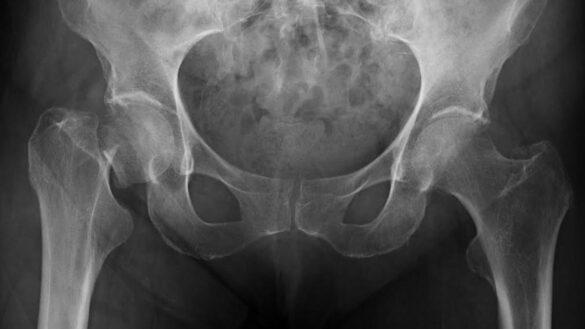 la-osteoporosis,-la-razon-por-la-que-nuestro-riesgo-de-fractura-osea-aumenta-cuando-somos-mayores